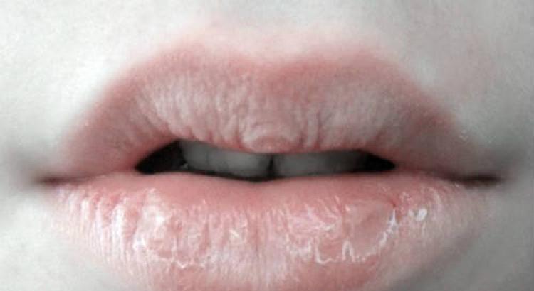 Простые и результативные варианты, как вылечить обветренные губы